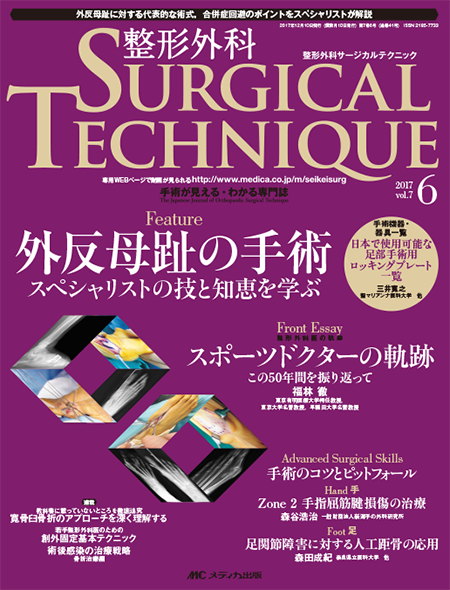 整形外科 SURGICAL TECHNIQUE 2017年6号　特集:外反母趾の手術 スペシャリストの技と知恵を学ぶ