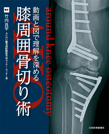 動画と図で理解を深める　膝周囲骨切り術（AKO)